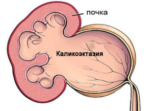 Каликоэктазия обеих почек. Беременность