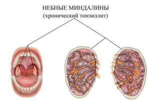 Хронический тонзиллит, категория годности.