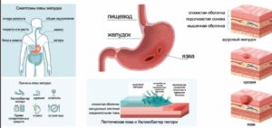 Как вылечить язву желудка 4х3см