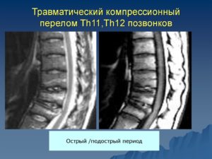 Компрессионный перелом 11 и 12 позвонков