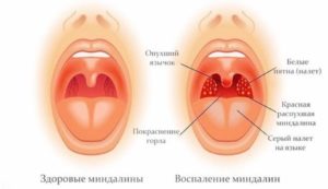 Ком в горле при ангине. Что делать?