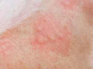 Контактный дерматит или аллергия у ребенка