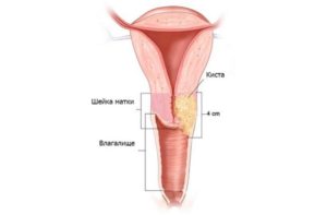 Киста на шейке матки