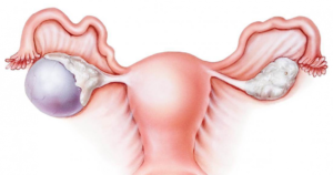 Киста яичника и гиперплазия эндометрия