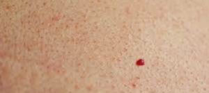 Мелкие красные точки на теле от спермы