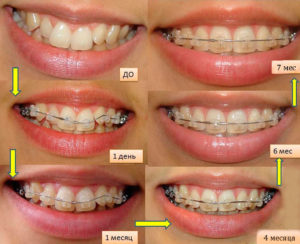 Искривились зубы после снятия брекетов