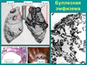 Буллы, эмфизема лёгких, чувство нехватки воздуха