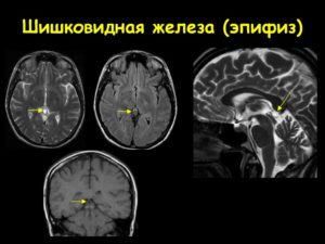 Кистовидная трансформация шишковидной железы с ее увеличением