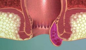 Боль в заднем проходе после дефекации