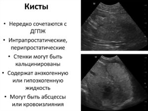 Кистозное расширение это киста?