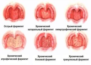 Красное горло после ОРВИ