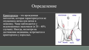 Крипторхизм неопущенное яичко