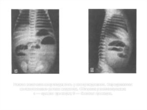 Инвагинация кишечника у новорожденного