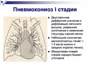 Легочный рисунок диффузно усилен,