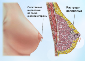 Болит и набухла грудь