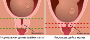 Магнезия и шейка матки при беременности