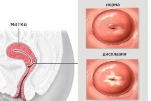 Хронический цервицит вместо дисплазии