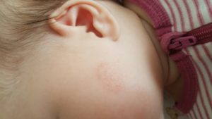 Красные шершавые пятна у трехмесячного ребенка