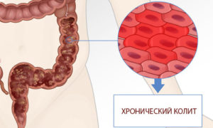 Хронический колит и отруби