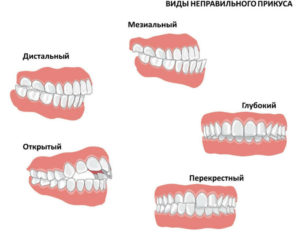 Болят зубы, может ли поменяться самостоятельно прикус