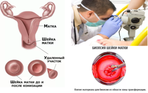 Кровянистые выделения после биопсии шейки матки