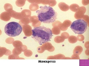 Лейкопения и моноцитоз после лечения описторхоза