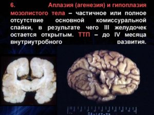 Частичная гипоплазия мозолистого тела