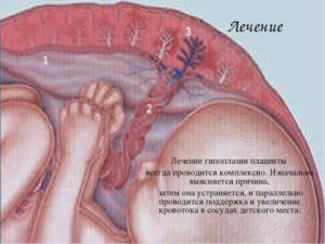 Лечение гиперплазии хориона клексаном