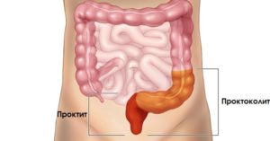 Колит+геморрой