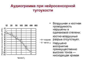 Будет ли тугоухостьот Анаурана при перфорации?