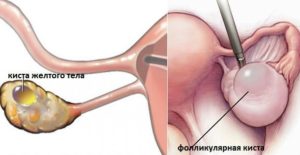 Киста жёлтого тела при приеме утрожестан