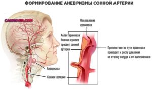 Боль в сонной артерии слева