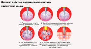 Большой сгусток крови после прижигание эрозии