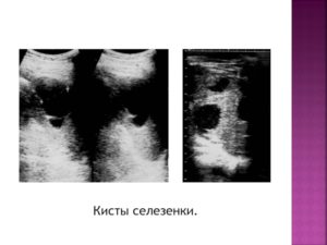 Киста селезенки