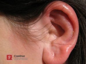Перелом/трешина в хряще уха