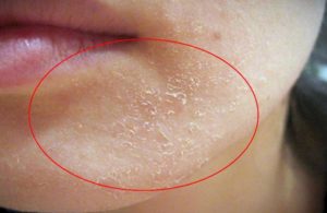 Малиновые шелушащиеся пятна на лице