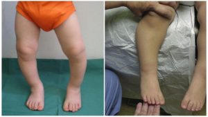 Кривые ножки у ребенка
