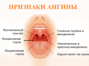 Хронический тонзиллит. Температура 37, просыпаюсь в мокром поту