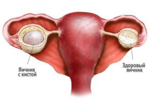 Киста яичника иногда боли в этом месте