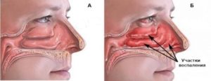 Периодическая слизь в горле, вазомоторный ринит