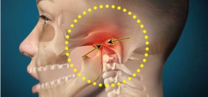 Боль в месте соединения челюстей