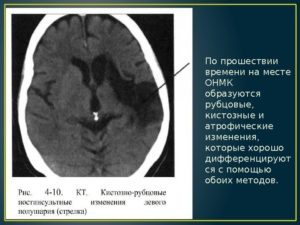 Кистозно атрофические изменения