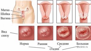 Кровотечение, гемоглобин 47 при раке шейки матки