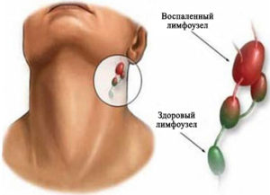 Лимфоузлы и герпес