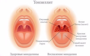 Хронический тонзиллит и ревматоидный фактор