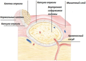 Липома, фибромиксома