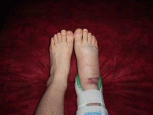 Перелом ноги или разрыв связок?