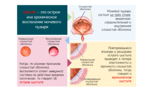 Как вылечить хронический цистит