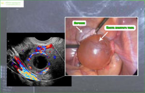 Киста желтого тела, очень болит
