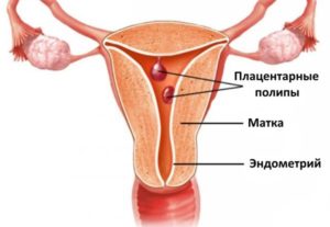 Лечение плацентарного полипа после выкидыша